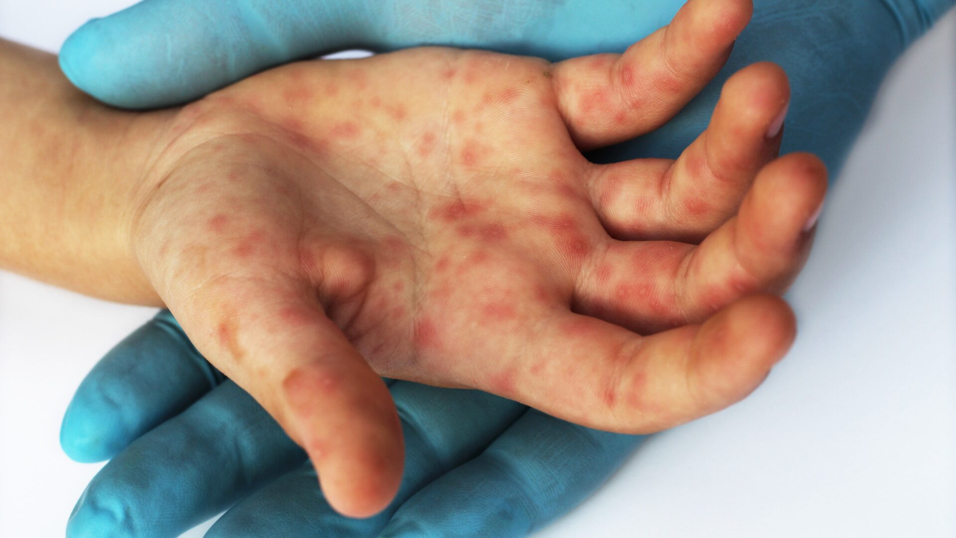 Mumbai Grapples with Rising HFMD Infections