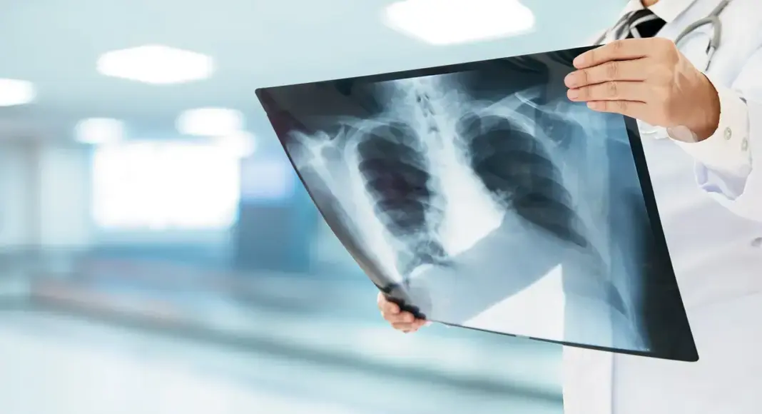 Over 54000 TB Cases Reported In Mumbai Cure Rate Improves