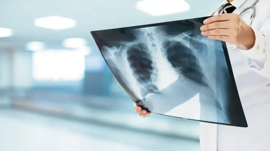 Over 54000 TB Cases Reported In Mumbai Cure Rate Improves